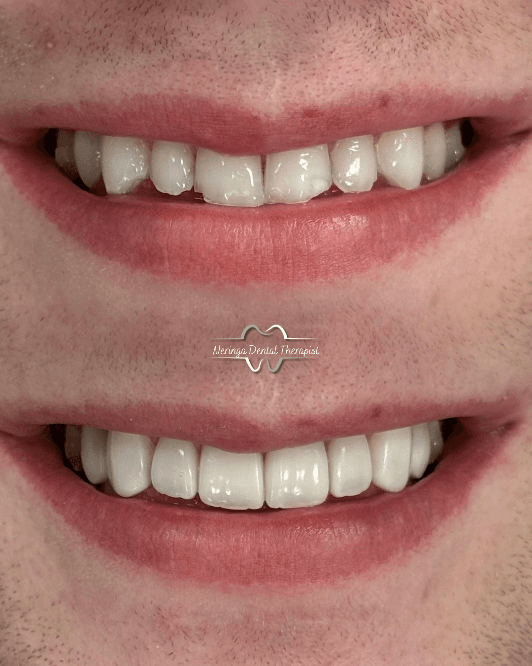 Bespoke Composite Bonding